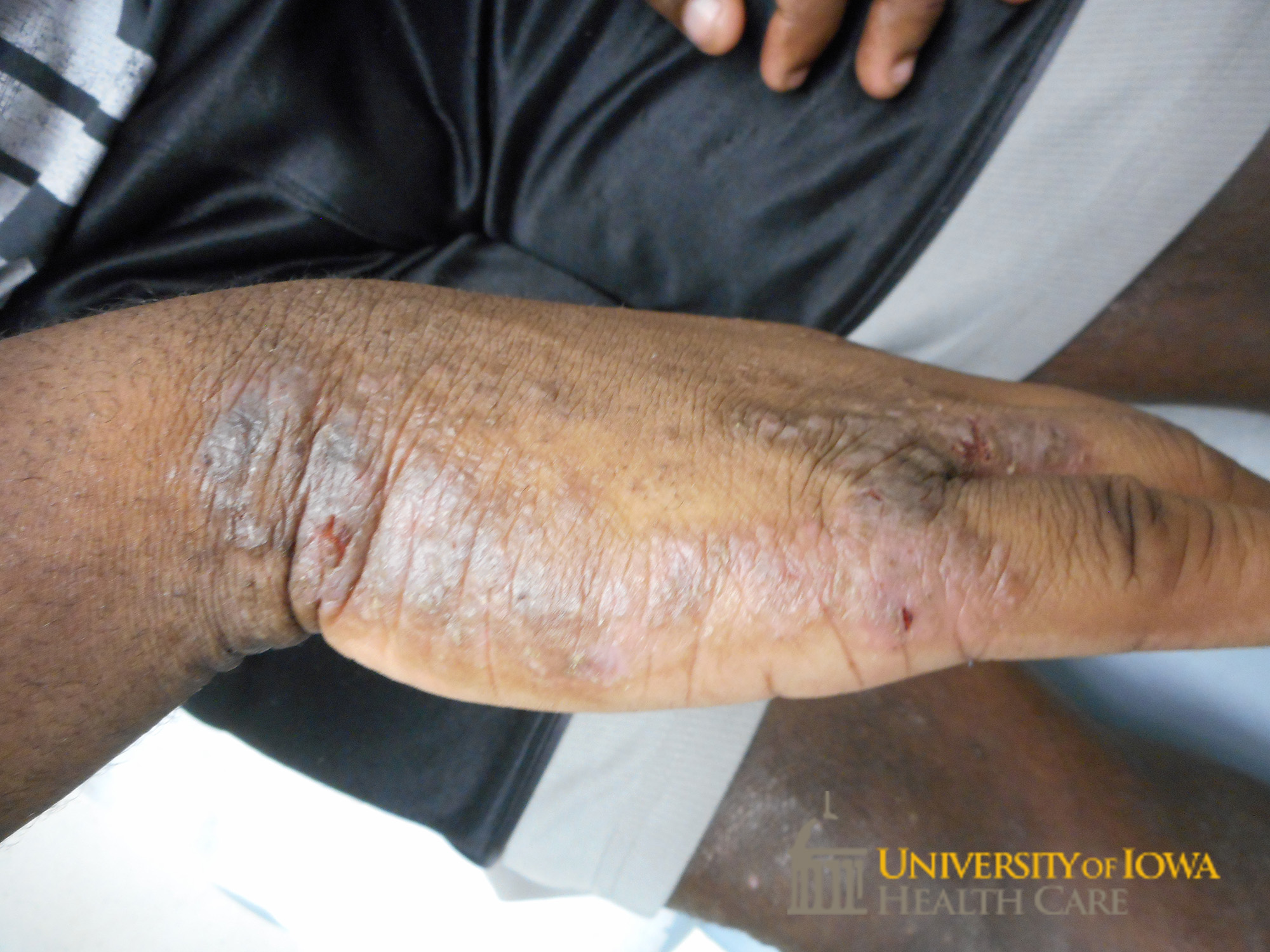 Pink to hyperpigmented lichenified scaly plaques on the hand. (click images for higher resolution).